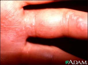 Herpes zoster (shingles) on the hand and fingers
