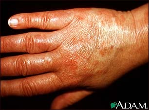 Vasculitis - urticarial on the hand