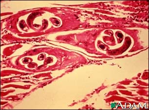 Trichinella spiralis in human muscle