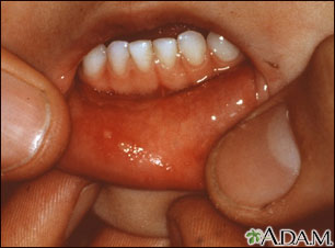 Hand, foot, and mouth disease - mouth