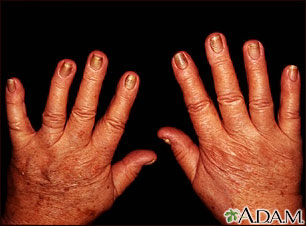 Yellow nails: MedlinePlus Medical Encyclopedia Image