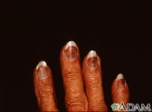 Cryoglobulinemia - fingers