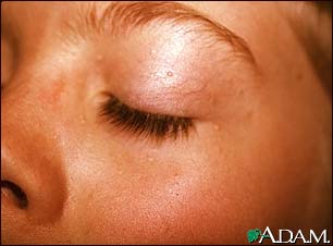Basal cell nevus syndrome