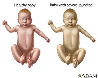 Infant jaundice - Indication