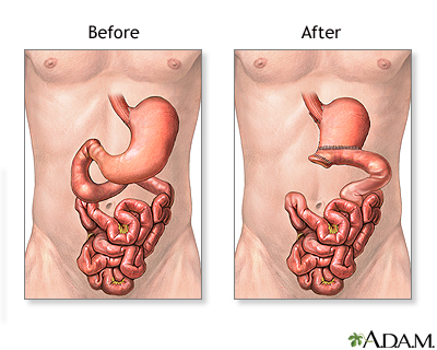 Before and after gastrectomy