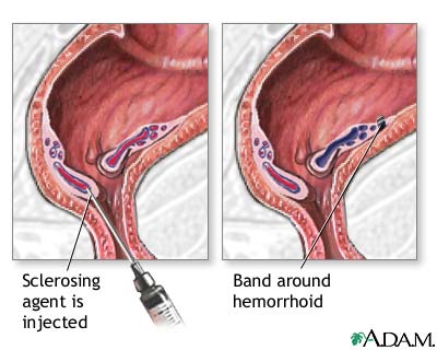 nakomelingen dichtheid Impasse Hemorrhoid surgery - series—Procedure: MedlinePlus Medical Encyclopedia