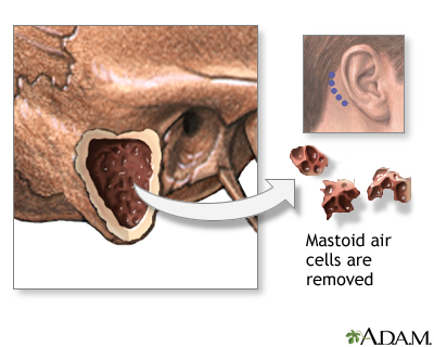 Mastoidectomy - Procedure