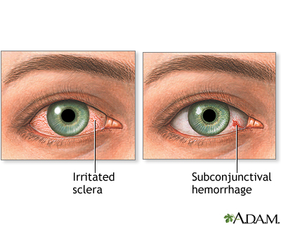 Can you wear contacts with broken blood vessel in eye Eye Redness Medlineplus Medical Encyclopedia