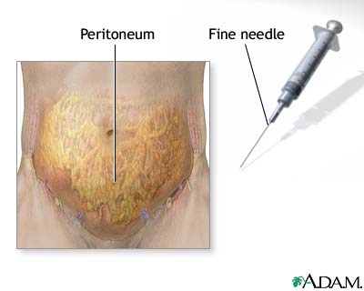 Peritoneal sample