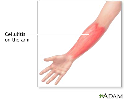 Cellulitis on the arm