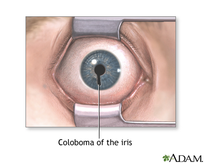 Coloboma of the iris