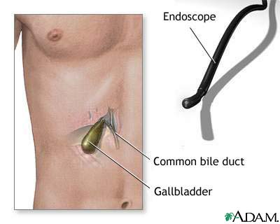 Gallbladder endoscopy