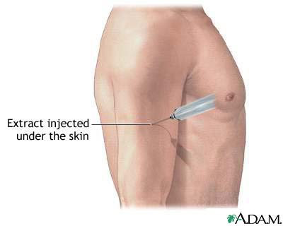 Antigen injection