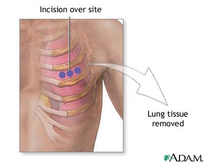 Incision for lung biopsy