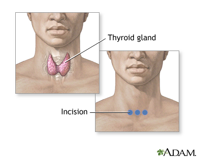 Incision for thyroid gland surgery