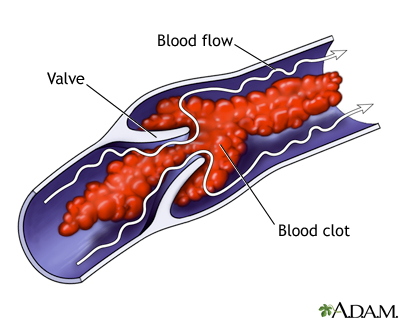 Venous blood clot
