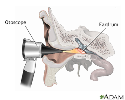Otoscopic exam of the ear