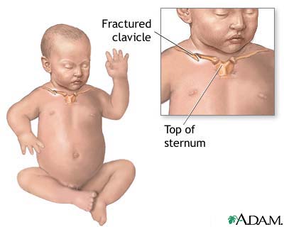 Fractured clavicle (infant)