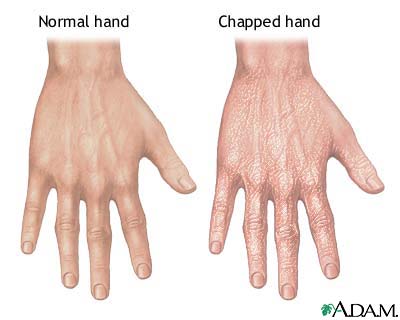 Chapped hands