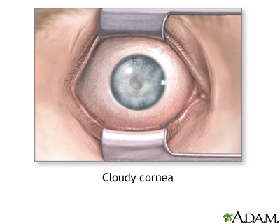 Cloudy cornea