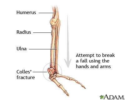 Colles fracture