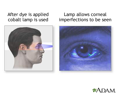 Fluorescent eye test