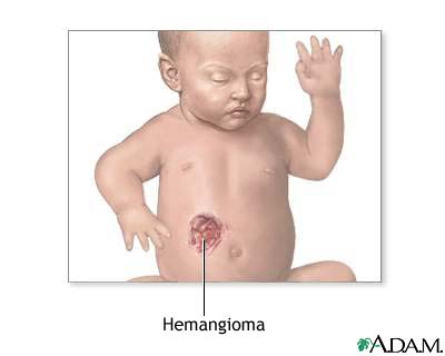 Hemangioma excision