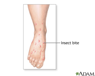 Insect bites and stings: MedlinePlus Medical Encyclopedia Image