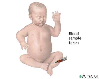 Infant blood sample
