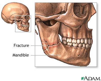 Mandibular fracture