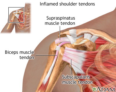 Inflamed shoulder tendons
