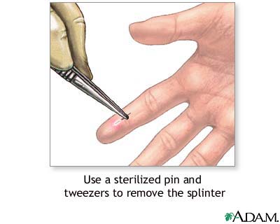 Splinter removal: MedlinePlus Medical Encyclopedia