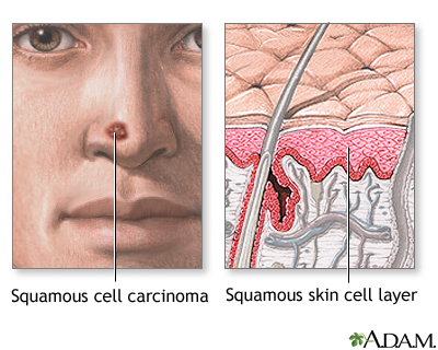 Squamous cell skin cancer: MedlinePlus Medical Encyclopedia
