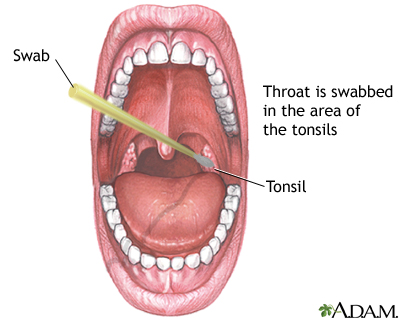 moeder Vast en zeker Platteland Strep throat: MedlinePlus Medical Encyclopedia