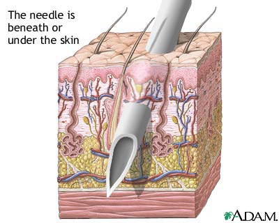 Skin layers and needles