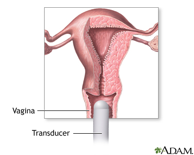 Transvaginal ultrasound: MedlinePlus Medical Image