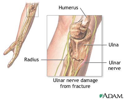Ulnar nerve damage