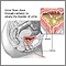 Bladder catheterization - female