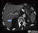 Adrenal metastases - CT scan