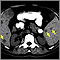 Spleen metastasis - CT scan