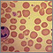 Red blood cells - spherocytosis