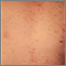 Chickenpox - lesions on the chest