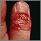 Herpetic whitlow on the thumb