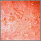 Dermatitis, herpetiformis - close-up of lesion