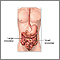 Intestinal obstruction repair - series