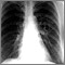 Coccidioidomycosis - chest X-ray