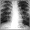 Sarcoid, stage II - chest X-ray