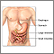 Inflammatory bowel disease - series