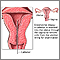 Endometrial biopsy