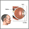 CMV retinitis
